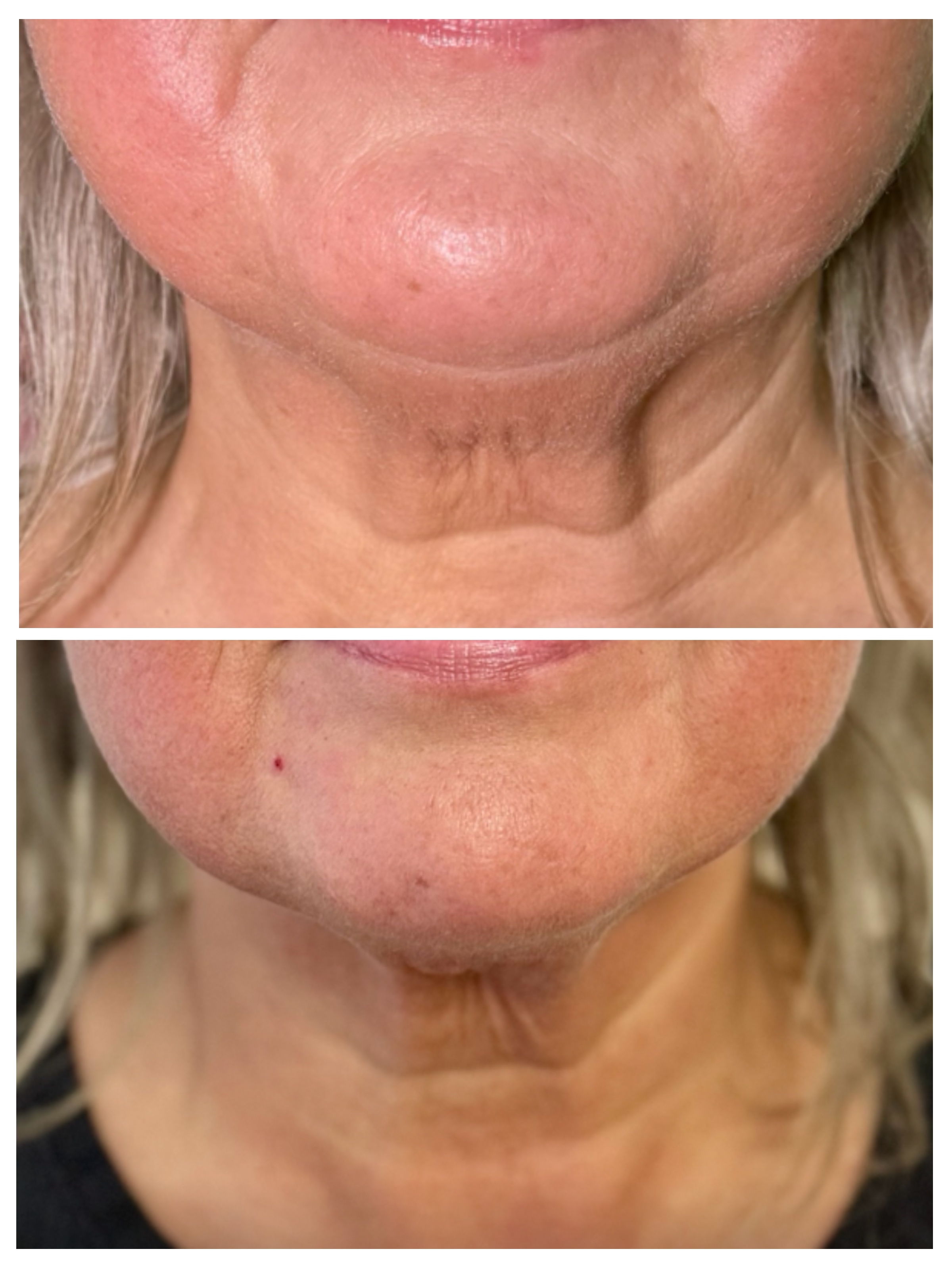Efekt przed i po — Liftia Clinic
